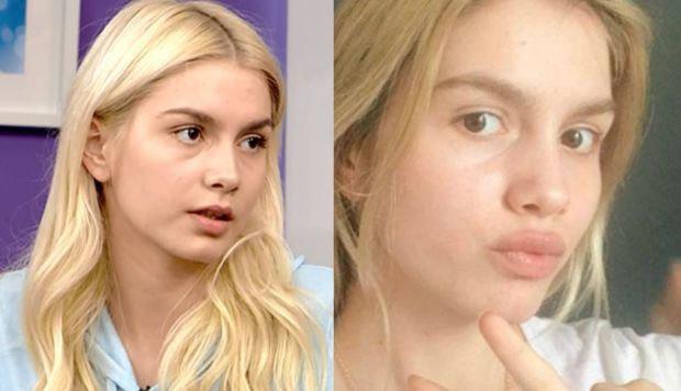 Aleyna Tilki estetik əməliyyatdan sonra - FOTO