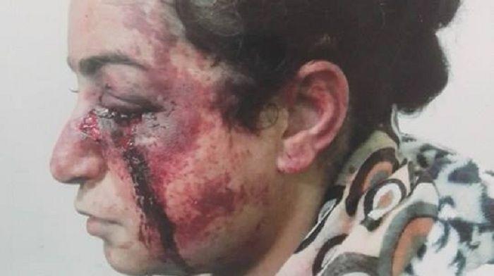 Şəkli yayılan döyülmüş qadın əslində kimdir? - FOTO +18