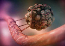 Xərçəng müalicəsində yeni dövr: Kemoterapiyasız tam sağalma