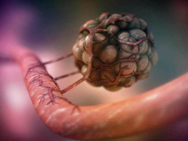 Xərçəng müalicəsində yeni dövr: Kemoterapiyasız tam sağalma