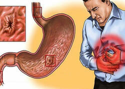 Xroniki qastrit diaqnozu biopsiyasız qoyulmamalıdır - AÇIQLAMA