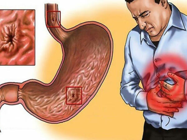 Xroniki qastrit diaqnozu biopsiyasız qoyulmamalıdır - AÇIQLAMA