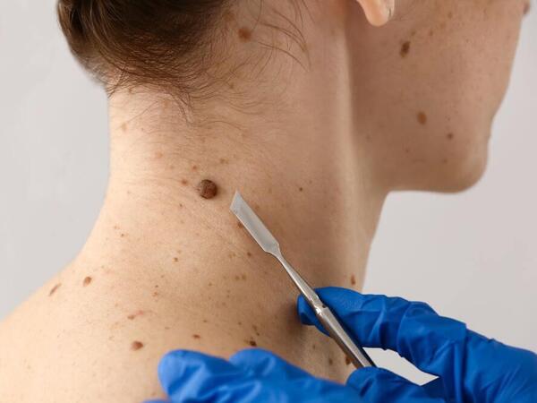 Dəridəki xallar nə vaxt təhlükəlidir? - Onkoloqdan açıqlama