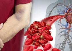 Bu, həyatınızı xilas edə bilər: Qanın laxtalanmasının 5 əlaməti