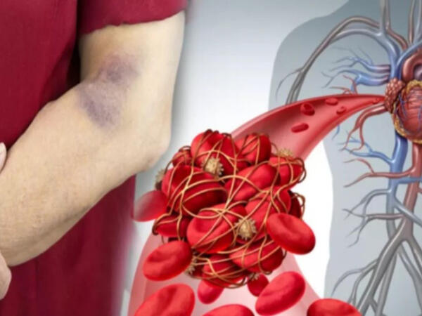 Bu, həyatınızı xilas edə bilər: Qanın laxtalanmasının 5 əlaməti