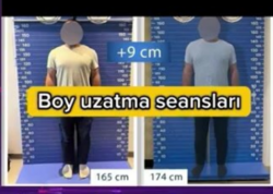 Sosial şəbəkələrdə paylaşılan aparatla 9 santimentrə qədər boy uzadılır? - <span class="color_red">VİDEO</span>