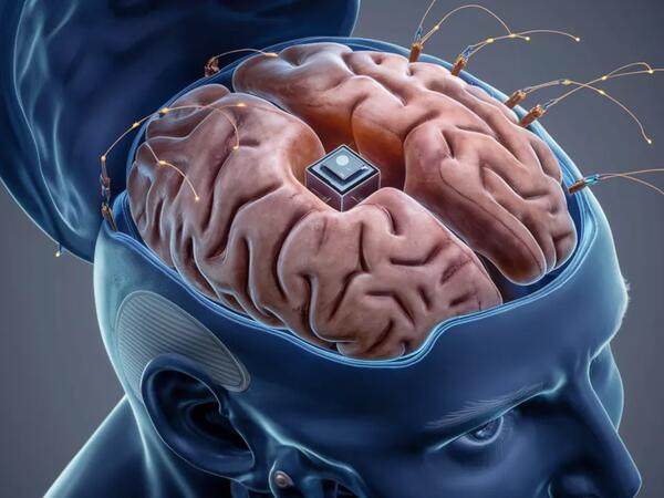 İnsan-beyin interfeysi reallığa çevrildi – &quot;Neuralink&quot;dən uğurlu nəticələr