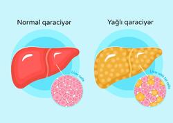 Yağlı qaraciyər xəstəliyinin qarşısını almaq mümkündür – 5 əsas qayda