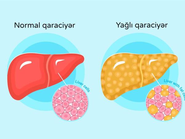 Yağlı qaraciyər xəstəliyinin qarşısını almaq mümkündür – 5 əsas qayda