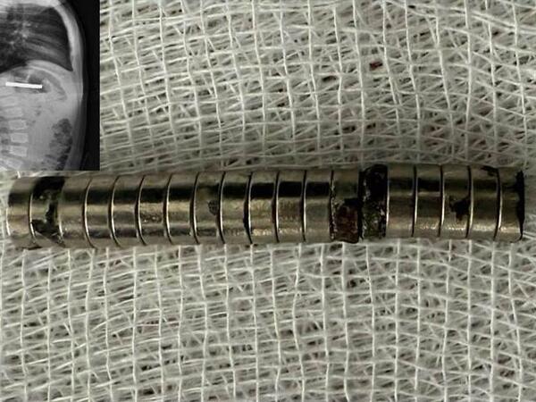 3 yaşlı uşağın boğazından 19 maqnit çıxarıldı - FOTO