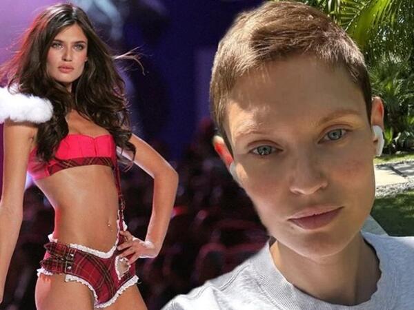 Xərçənglə mübarizə aparan model &quot;Victoria's Secret&quot; şousuna qəbul edilmədi