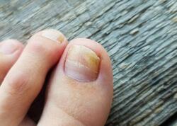 Pambıq və ya fırça ilə dırnağa çəkin - göbələyin kökünü kəsir