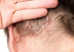 Başdakı sızanaqlar bu problemlərdən xəbər verə bilər