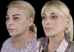 Əməkdar artist əməliyyatla tanınmaz hala düşdü - <span class="color_red">FOTO</span>