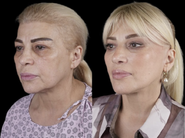 Əməkdar artist əməliyyatla tanınmaz hala düşdü - <span class="color_red">FOTO</span>