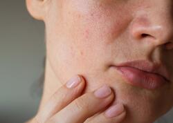 Dəri xərçəngindən bu sadə üsulla qorunmaq olar