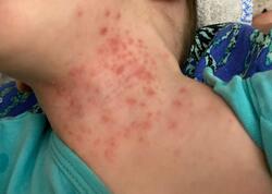 Uşaqlar arasında yeni virus yayılıb? - AÇIQLAMA