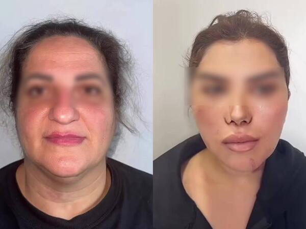 60 yaşlı qadını əməliyyatla bu hala saldılar - VİDEO