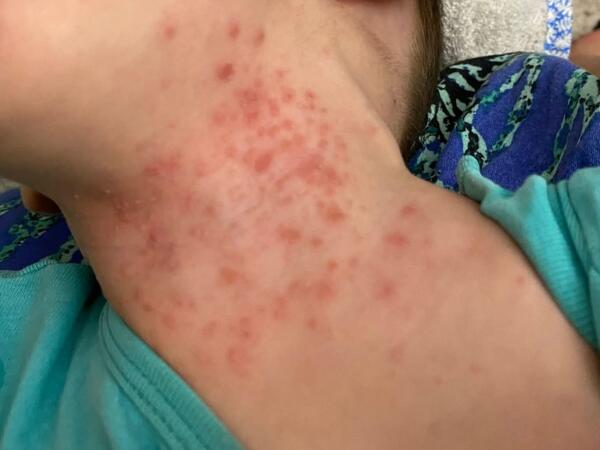 Uşaqlar arasında yeni virus yayılıb? - AÇIQLAMA