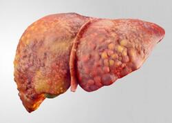 Qaraciyər yağlanıbsa ölüm riski 35 dəfə artır