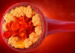 Ailənizdə infarkt olan varsa... - Araşdırmanın qorxunc nəticələri üzə çıxdı