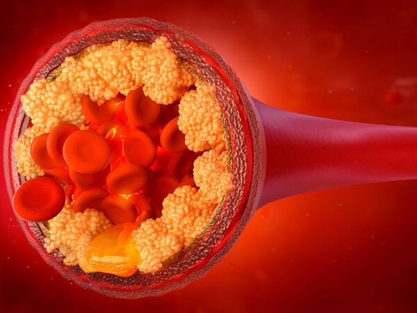 Ailənizdə infarkt olan varsa... - Araşdırmanın qorxunc nəticələri üzə çıxdı