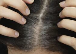 Saçlar niyə vaxtından tez ağarır? - Stresslə əlaqəsi yoxdur