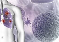 Azı gündə 3 dəfə yeyirik - Ağciyər xərçəngi yaradır