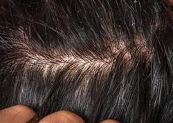 Çox addam ciddiyə almır - Ağır xəstəliklərin əlaməti ola bilər