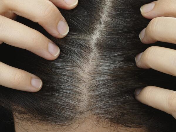 Saçlar niyə vaxtından tez ağarır? - Stresslə əlaqəsi yoxdur