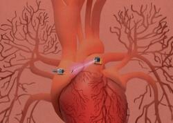 Robot ağrıkəsicilər hazırlandı - Toxumanı tapıb sağaldır, sonra da yox olur