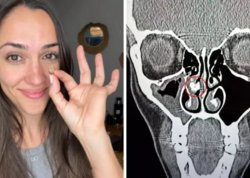 Qadının burnundan görün nə çıxdı - 35 ildir belə yaşayıbmış...