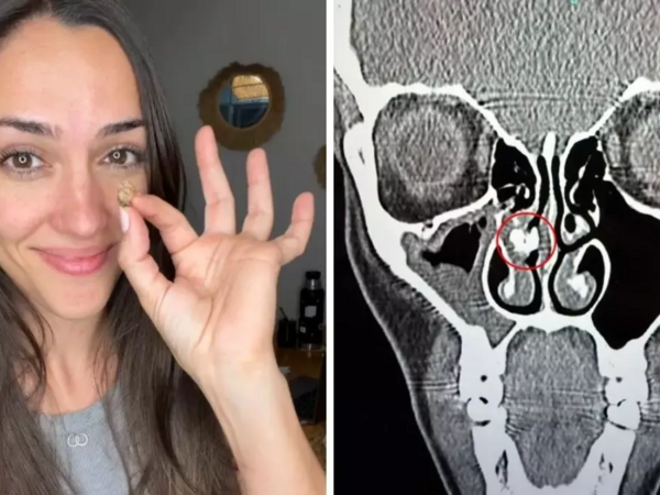 Qadının burnundan görün nə çıxdı - 35 ildir belə yaşayıbmış...