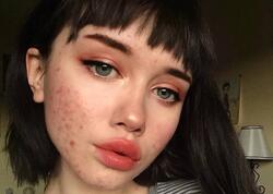 Sızanaqların yaranmasının gözlənilməz səbəbi açıqlandı