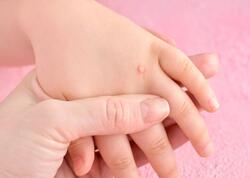 Sarımsaq əzməsini ziyilin üstünə vurun - Yox edəcək