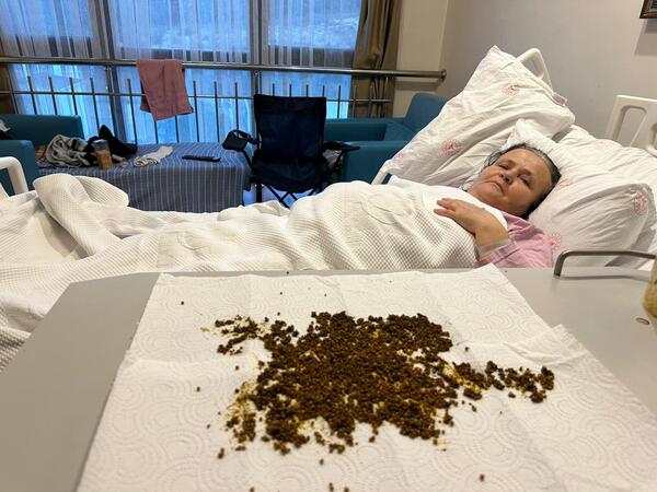 Qarın ağrısından şikayət etdi, ödündən 20 mindən çox daş çıxdı - <span class="color_red">FOTO</span>