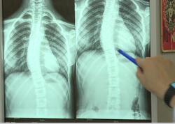 Son zamanlar “8-12” yaş arası uşaqlarda bel və boyun ağrılarının səbəbi