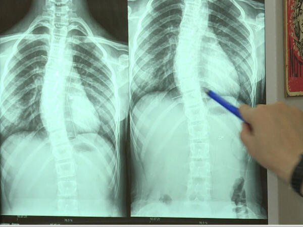 Son zamanlar “8-12” yaş arası uşaqlarda bel və boyun ağrılarının səbəbi