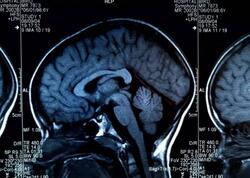 Beyni məhv edən qidalar açıqlandı - Hər gün yeyirik