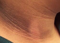 Dibaetin erkən əlamətləri - Dəridə belə izlər yaranır