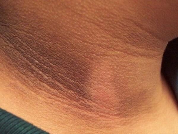 Dibaetin erkən əlamətləri - Dəridə belə izlər yaranır