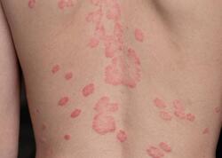 Beldəki səpkilərin yaranma səbəbi açıqlandı