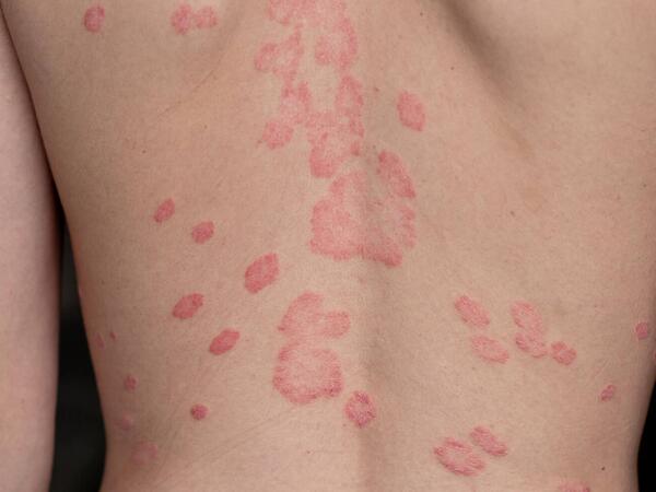 Beldəki səpkilərin yaranma səbəbi açıqlandı