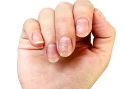 Çinko çatışmazlığı nələrə səbəb olur - problemi aradan qaldırmağın <span class="color_red">yolları</span>