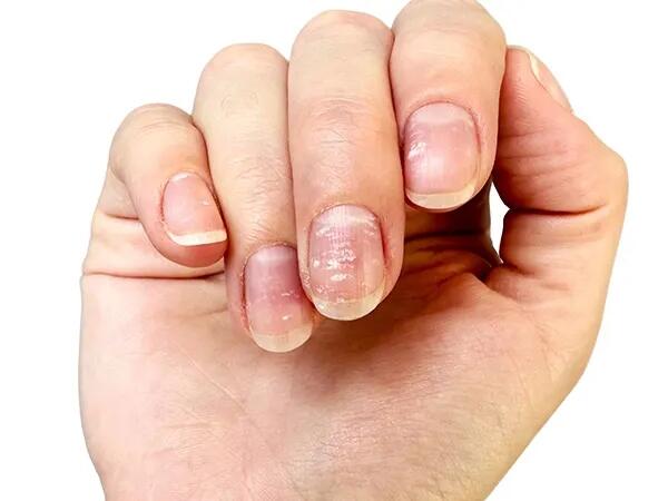 Çinko çatışmazlığı nələrə səbəb olur - problemi aradan qaldırmağın <span class="color_red">yolları</span>