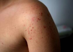 Bu virus dəmir dövründən bəri var imiş