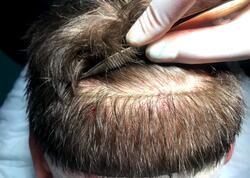 47 yaşlı kişi saç əkimi zamanı öldü