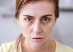 Üzün solğun olması hər zaman qanazlığı demək deyil - Həkim