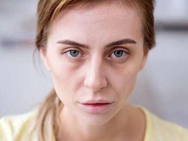 Üzün solğun olması hər zaman qanazlığı demək deyil - Həkim