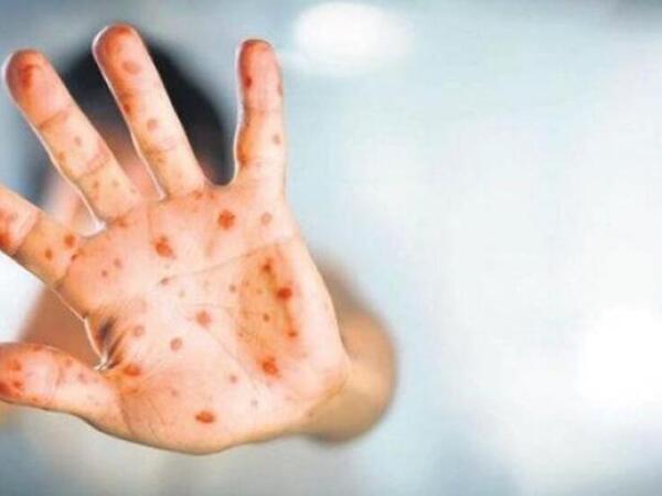 Meymunçiçəyi həmsərhəd ölkədə - <span class="color_red">Azərbaycanda yoluxma qeydə alınıb?</span>